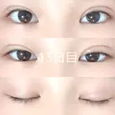 二重埋没 / 上まぶたの脂肪取り 品川スキンクリニック沖縄院 DAY 14 サムネイル用