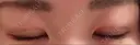 二重埋没 / 上まぶたの脂肪取り TCB東京中央美容外科 江坂院 DAY 9 サムネイル用