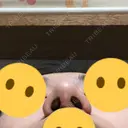 隆鼻術 / 鼻尖形成（切開） / 鼻中隔延長（切開） / 小鼻縮小（切開） / 軟骨移植 / 鼻孔縁挙上 / 鼻尖縮小 Zetith Beauty Clinic 銀座院 DAY 91 サムネイル用