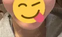 糸リフト FROM B整形外科 (旧バウム整形外科) AFTER サムネイル用