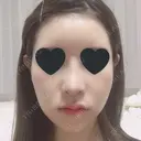 鼻尖形成（切開） / 鼻中隔延長（切開） / 小鼻縮小（切開） / その他（鼻） / 軟骨移植 / 骨切幅寄せ / 眉間プロテーゼ / プロテーゼ除去 / 鼻修正 / 鼻尖縮小 FROM B整形外科 (旧バウム整形外科) DAY 10 サムネイル用