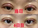 二重切開 こうべ花時計クリニック DAY 6 サムネイル用
