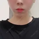 ヒアルロン酸注入（あご） TCB東京中央美容外科 福島院 DAY 8 サムネイル用