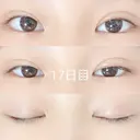 二重埋没 / 上まぶたの脂肪取り 品川スキンクリニック沖縄院 DAY 17 サムネイル用