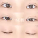 二重埋没 / 上まぶたの脂肪取り 品川スキンクリニック沖縄院 DAY 16 サムネイル用