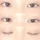 二重埋没 / 上まぶたの脂肪取り 品川スキンクリニック沖縄院 DAY 15 サムネイル用