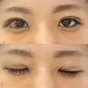 二重埋没 湘南美容クリニック 松山院 DAY 6 サムネイル用