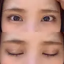 二重埋没 ビスポーククリニック 福岡院 DAY 48 サムネイル用