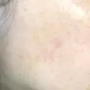 YAGレーザー 新宿美容外科クリニック 横浜院 AFTER サムネイル用