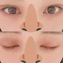 二重埋没 / 眼瞼下垂（切開） / その他（目元） 湘南美容クリニック 福島院 DAY 5 サムネイル用