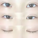 二重埋没 / 上まぶたの脂肪取り 品川スキンクリニック沖縄院 DAY 18 サムネイル用