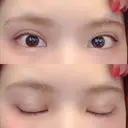 二重埋没 ビスポーククリニック 福岡院 DAY 49 サムネイル用