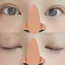 二重埋没 / 眼瞼下垂（切開） / その他（目元） 湘南美容クリニック 福島院 DAY 6 サムネイル用