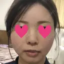 脂肪注入（輪郭） テラクリニック DAY 22 サムネイル用