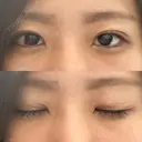 二重埋没 湘南美容クリニック 松山院 DAY 12 サムネイル用