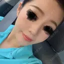 隆鼻術 / 鼻尖形成（切開） / 鼻中隔延長（切開） / 小鼻縮小（切開） / 鼻尖縮小 FROM B整形外科 (旧バウム整形外科) DAY 70 サムネイル用