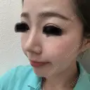 隆鼻術 / 鼻尖形成（切開） / 鼻中隔延長（切開） / 小鼻縮小（切開） / 鼻尖縮小 FROM B整形外科 (旧バウム整形外科) DAY 70 サムネイル用