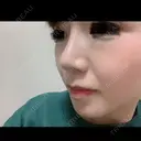 隆鼻術 / 鼻尖形成（切開） / 鼻中隔延長（切開） / 小鼻縮小（切開） / 鼻尖縮小 FROM B整形外科 (旧バウム整形外科) DAY 330 サムネイル用