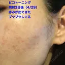 美肌レーザー / シミ取りレーザー / ピコレーザートーニング（美白・肝斑） 湘南美容クリニック 秋葉原院 DAY 3 サムネイル用
