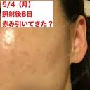 美肌レーザー / シミ取りレーザー / ピコレーザートーニング（美白・肝斑） 湘南美容クリニック 秋葉原院 DAY 8 サムネイル用