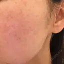 美肌レーザー / シミ取りレーザー / ピコレーザートーニング（美白・肝斑） 湘南美容クリニック 秋葉原院 DAY 14 サムネイル用