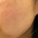 美肌レーザー / シミ取りレーザー / ピコレーザートーニング（美白・肝斑） 湘南美容クリニック 秋葉原院 DAY 14 サムネイル用