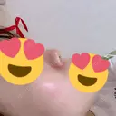 鼻尖形成（切開） / ヒアルロン酸注入（鼻） 東京ヒルズクリニック 新宿院 DAY 13 サムネイル用