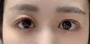 二重切開 / その他（目元） マーブル美容整形外科 DAY 6 サムネイル用