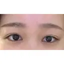 二重埋没 湘南美容クリニック 福島院 AFTER サムネイル用