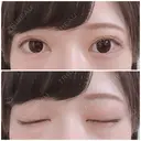 二重切開 / 上まぶたたるみ取り / 上まぶたの脂肪取り 銀座高須クリニック DAY 121 サムネイル用