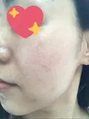 美肌レーザー / シミ取りレーザー / ピコレーザートーニング（美白・肝斑） 湘南美容クリニック 秋葉原院 DAY 21 サムネイル用