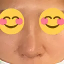 隆鼻術 たにまちクリニック DAY 7 サムネイル用