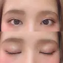 二重埋没 ビスポーククリニック 福岡院 DAY 59 サムネイル用