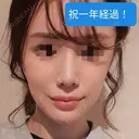 あごプロテーゼ / 骨削り（エラ） / 骨削り（頬） GNG美容外科 DAY 409 サムネイル用