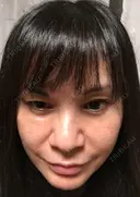 エレクトロポレーション / ピコレーザートーニング（美白・肝斑） / フラクショナルレーザー（毛穴・ニキビ跡） 麗ビューティー皮フ科クリニック AFTER サムネイル用