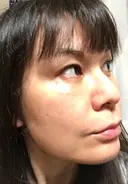 エレクトロポレーション / ピコレーザートーニング（美白・肝斑） / フラクショナルレーザー（毛穴・ニキビ跡） 麗ビューティー皮フ科クリニック DAY 15 サムネイル用