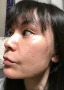 エレクトロポレーション / ピコレーザートーニング（美白・肝斑） / フラクショナルレーザー（毛穴・ニキビ跡） 麗ビューティー皮フ科クリニック DAY 15 サムネイル用