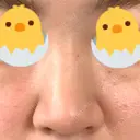 鼻尖形成（切開） / 鼻尖縮小 / ヒアルロン酸注入（鼻） 東京ヒルズクリニック 新宿院 AFTER サムネイル用