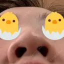 鼻尖形成（切開） / 鼻尖縮小 / ヒアルロン酸注入（鼻） 東京ヒルズクリニック 新宿院 DAY 162 サムネイル用