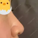 鼻尖形成（切開） / 鼻尖縮小 / ヒアルロン酸注入（鼻） 東京ヒルズクリニック 新宿院 DAY 162 サムネイル用