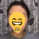 骨切り（あご） / 骨削り（エラ） ボンディ美容整形外科（旧リオン整形外科） DAY 80 サムネイル用