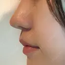 鼻尖形成（切開） / 小鼻縮小（切開） / スレッドノーズ / 鼻尖縮小 銀座TAクリニック DAY 12 サムネイル用
