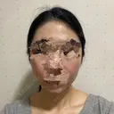 骨削り（頬） ボンディ美容整形外科（旧リオン整形外科） DAY 90 サムネイル用