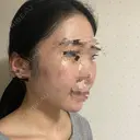 骨削り（頬） ボンディ美容整形外科（旧リオン整形外科） DAY 90 サムネイル用