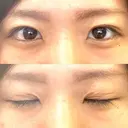 二重埋没 湘南美容クリニック 松山院 AFTER サムネイル用