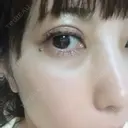 二重埋没 品川スキンクリニック沖縄院 DAY 10 サムネイル用