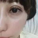 二重埋没 品川スキンクリニック沖縄院 DAY 10 サムネイル用