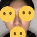 隆鼻術 / 鼻尖形成（切開） / 鼻中隔延長（切開） / 小鼻縮小（切開） / 軟骨移植 / 鼻孔縁挙上 / 鼻尖縮小 Zetith Beauty Clinic 銀座院 AFTER サムネイル用