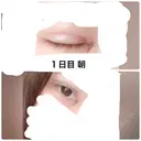 二重埋没 / 目頭切開 かめい美容クリニック宇都宮 DAY 1 サムネイル用