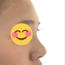 隆鼻術 たにまちクリニック DAY 11 サムネイル用